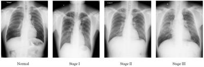 Accurate pneumoconiosis staging via deep texture encoding and discriminative representation learning